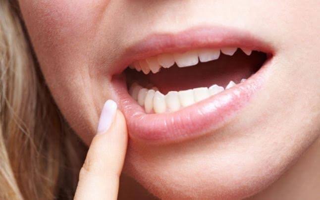 Cele mai grave afectiuni ale gingiilor – ce boli te pot lasa fara dantura