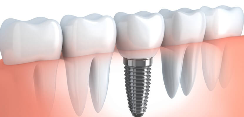Tot ce trebuie să cunoști despre un implant dentar